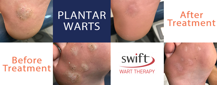 Before and After plantar warts treatment Scarborough